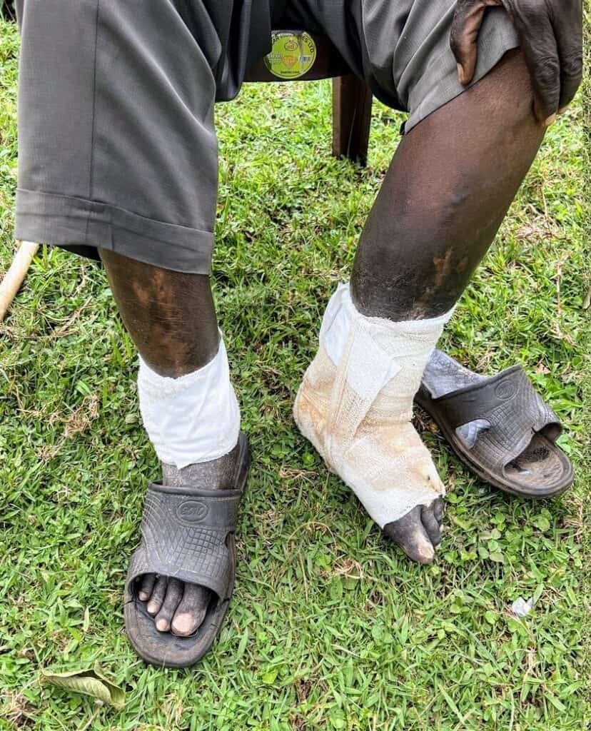 Close-up of Pastor David Shikambi Luvai's bandaged legs and feet, showing the effects of tropical ulcers.